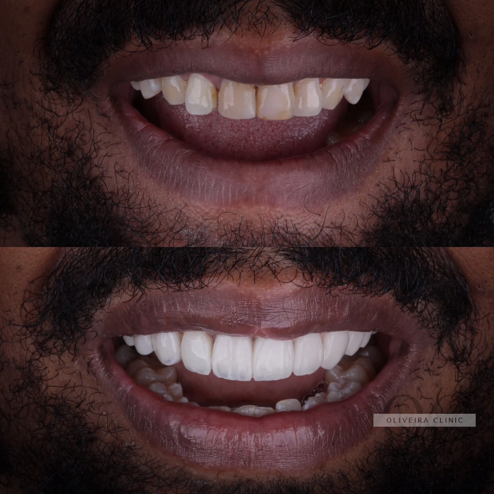 Antes e depois — Transformação Pós-Ortodontia na Oliveira Clinic