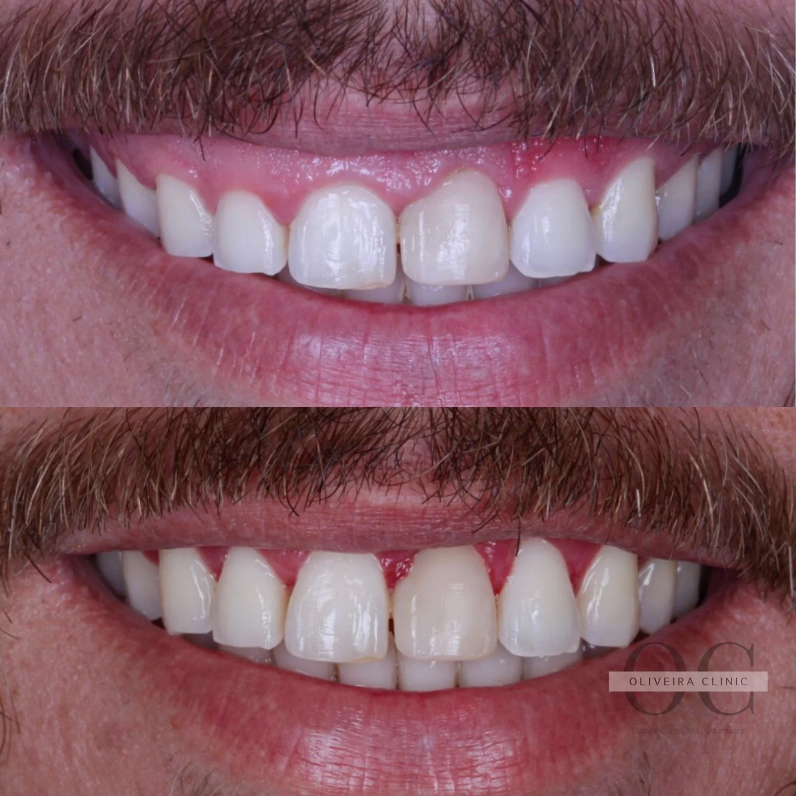 Antes e depois — Tratamento de Sorriso Gengival na Oliveira Clinic