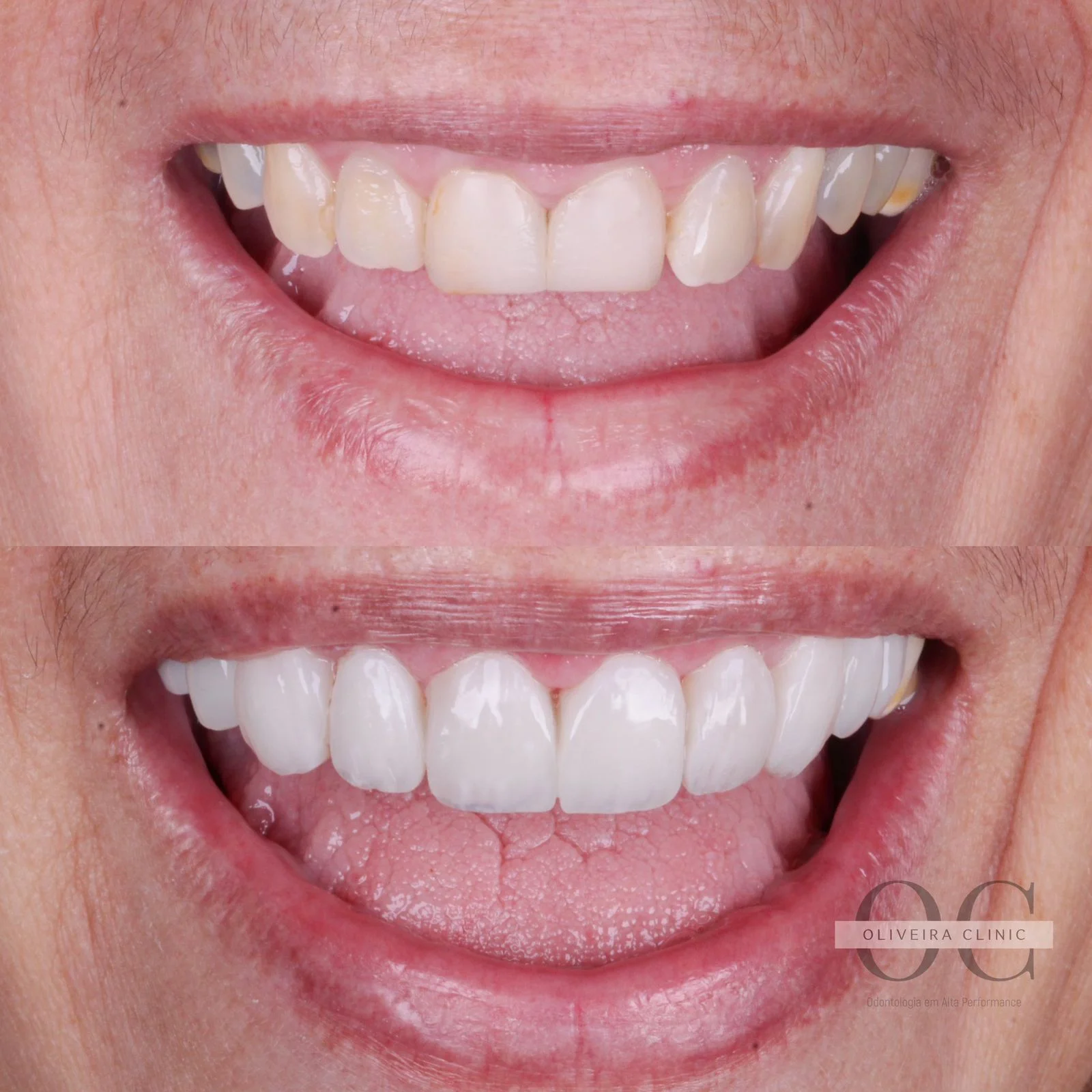 Antes e depois — Reabilitação com Coroas Estéticas na Oliveira Clinic