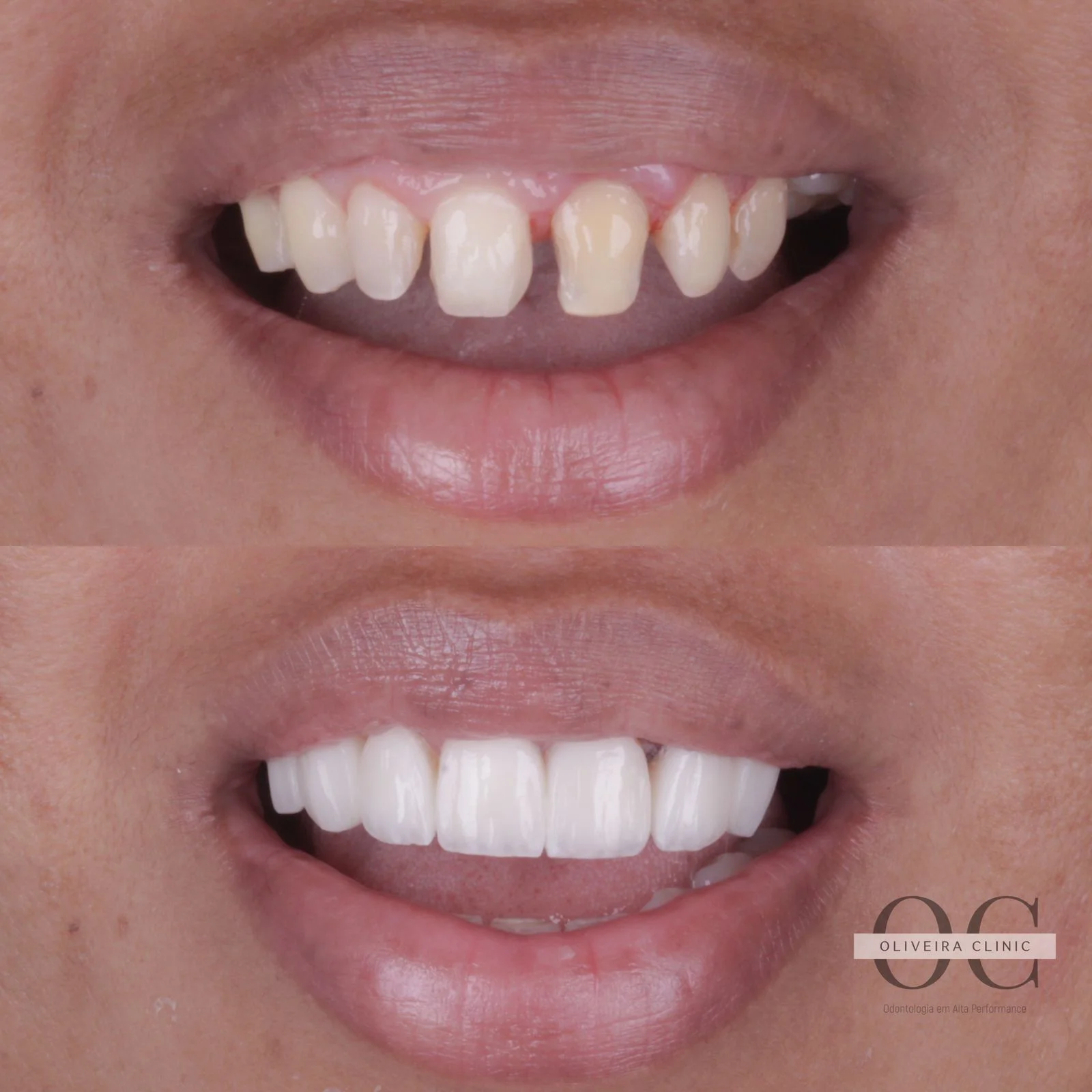 Antes e depois — Fechamento de Diastema Anterior na Oliveira Clinic