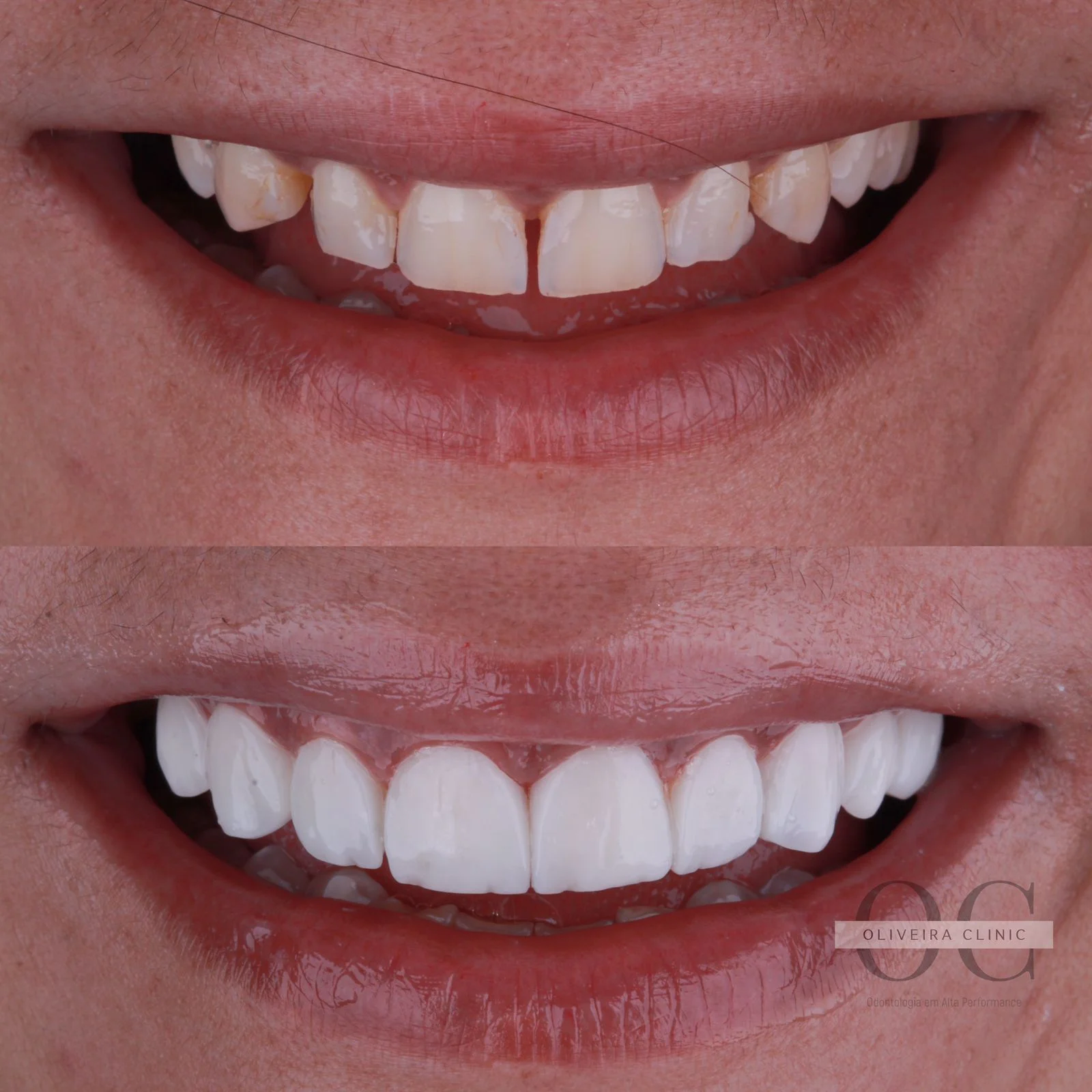 Antes e depois — Correção de Diastemas e Cor na Oliveira Clinic