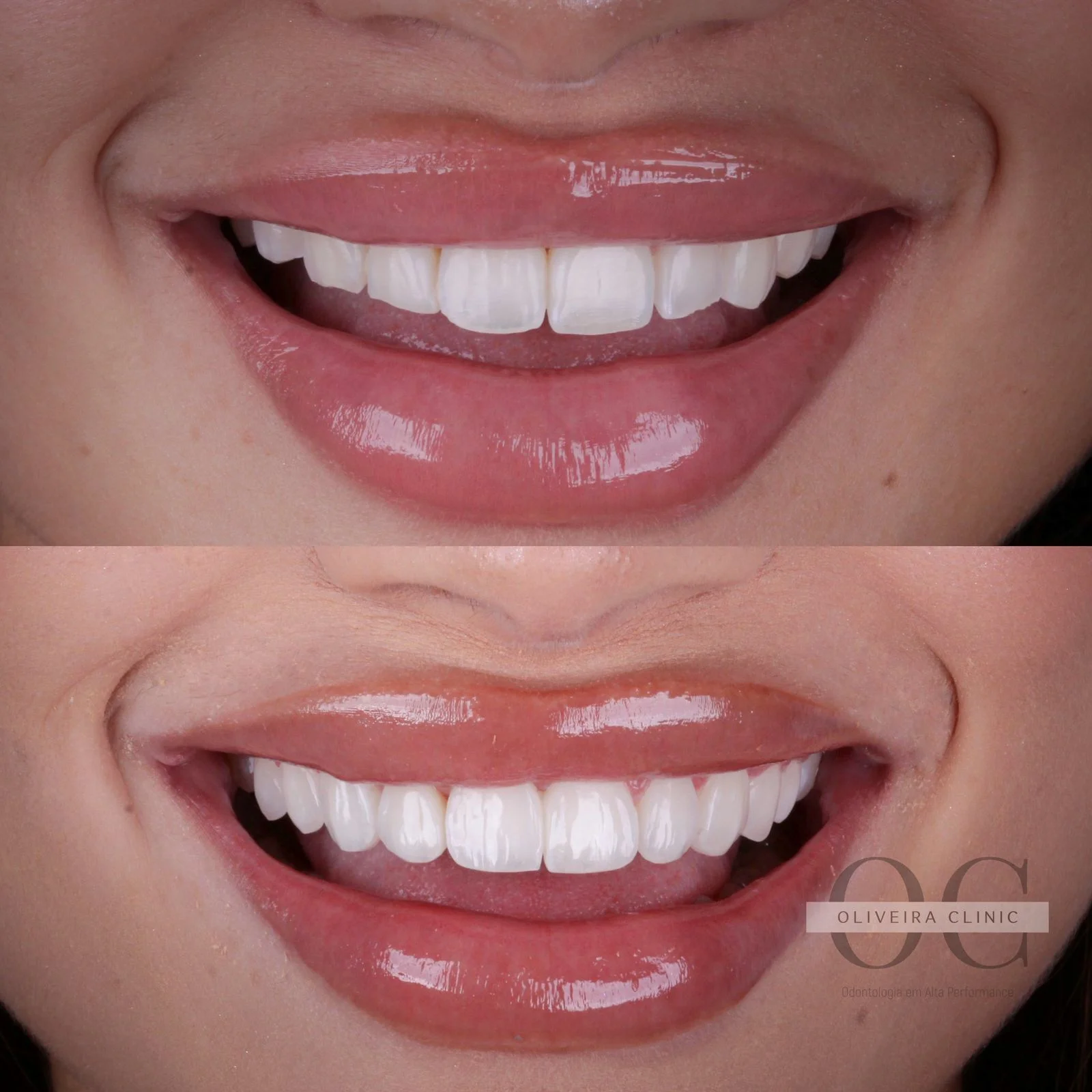 Antes e depois — Sorriso Feminino Harmônico na Oliveira Clinic