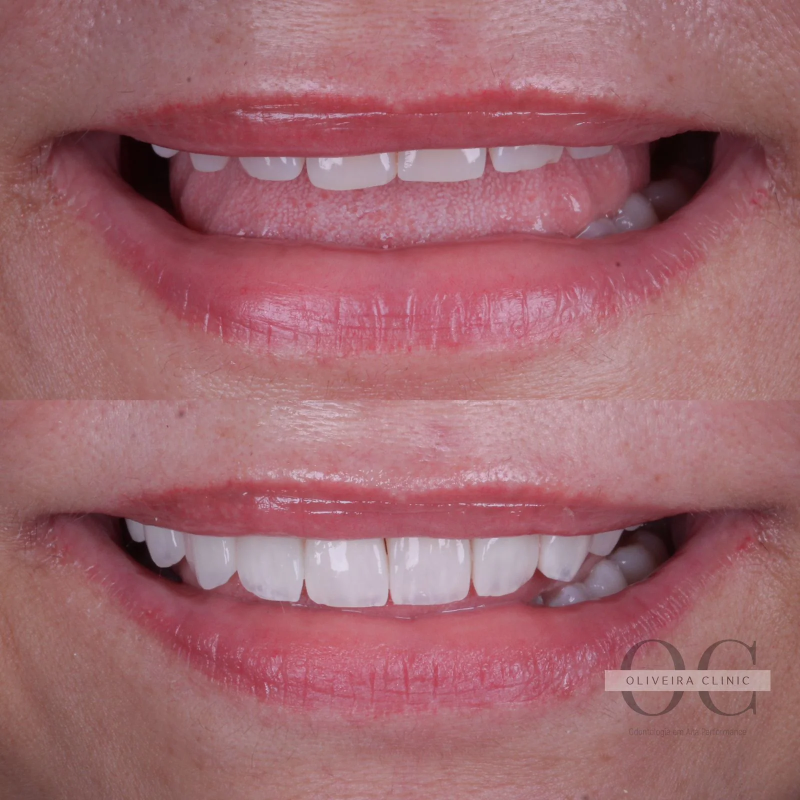 Antes e depois — Harmonização do Sorriso na Oliveira Clinic
