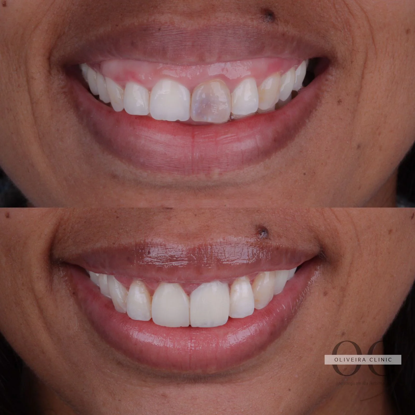 Antes e depois — Correção de Dente Escurecido na Oliveira Clinic