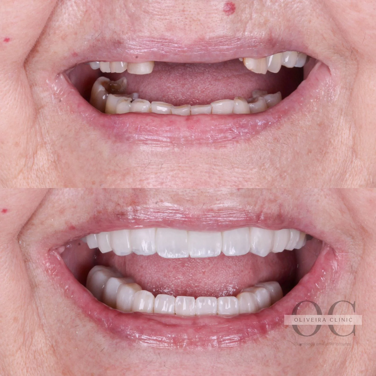Antes e depois — Protocolo Sobre Implantes