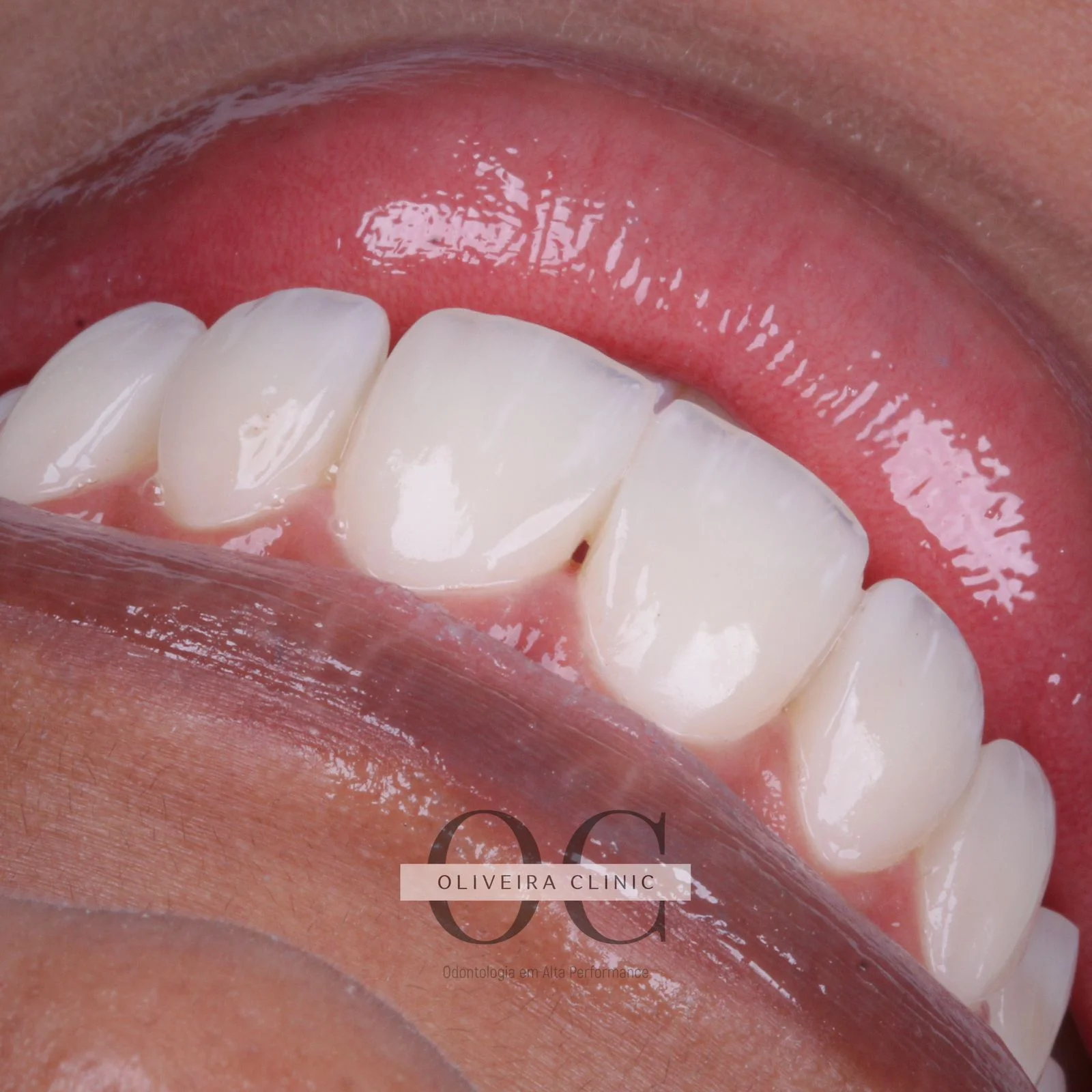 Antes e depois — Detalhe Macro Cerâmico na Oliveira Clinic