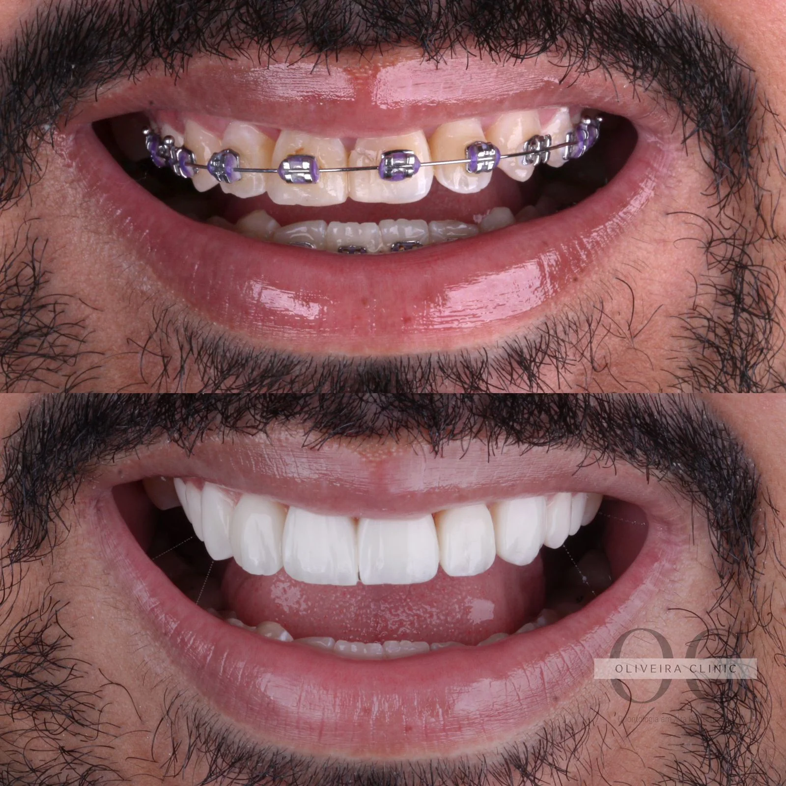 Antes e depois — Reabilitação com Lentes Cerâmicas