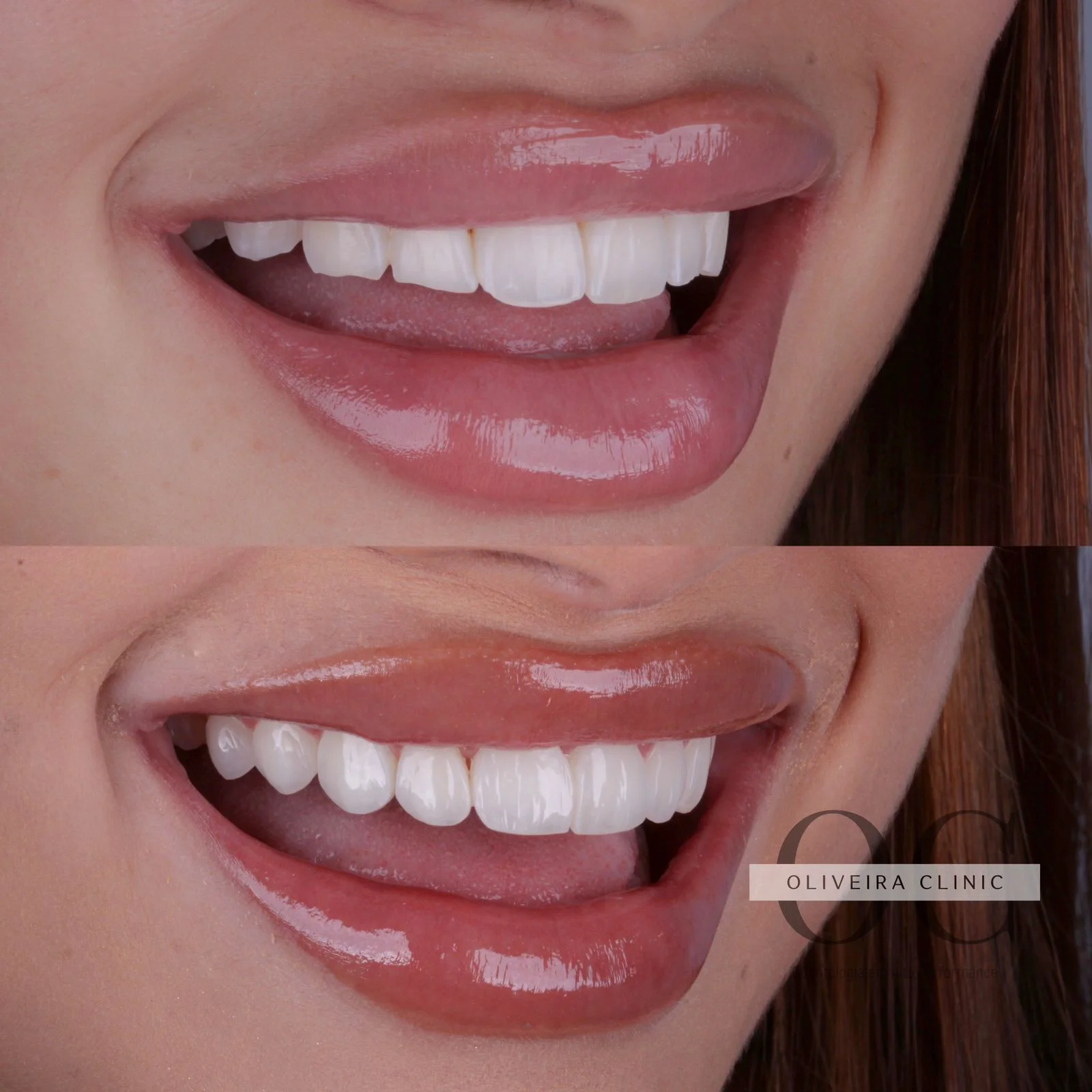 Antes e depois — Lentes Cerâmicas Brilho Glacial na Oliveira Clinic