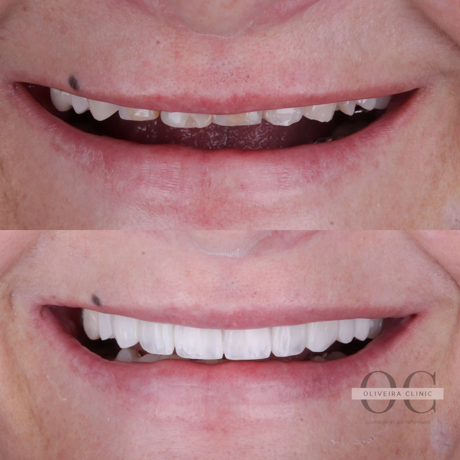 Antes e depois — Reabilitação Oral Completa na Oliveira Clinic