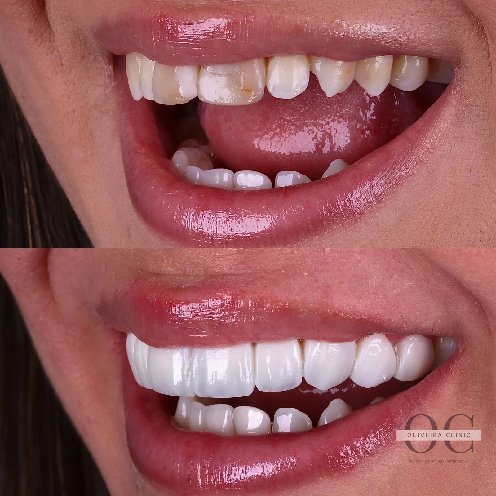 Antes e depois — Sorriso Feminino Premium na Oliveira Clinic