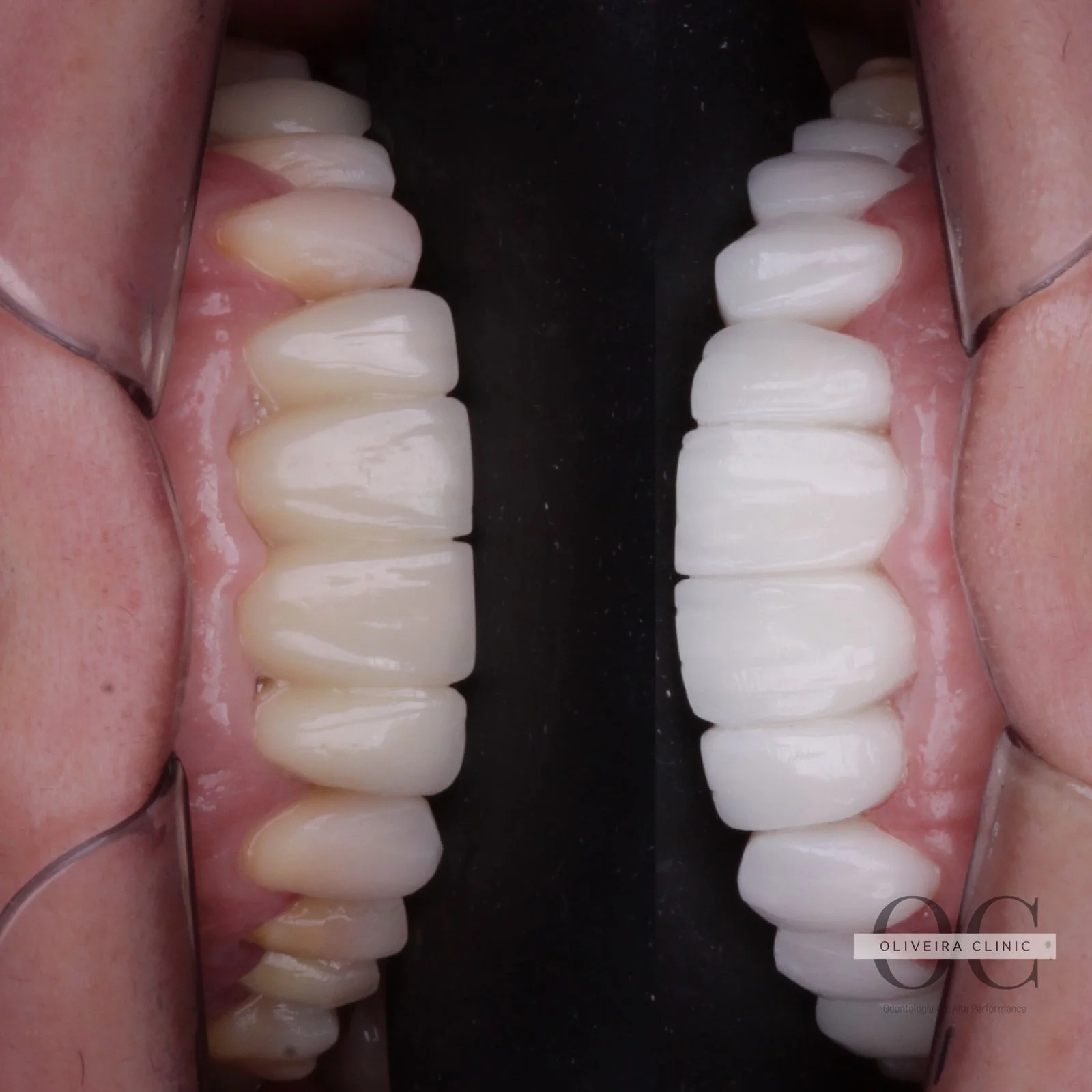 Antes e depois — Comparativo Antes e Depois na Oliveira Clinic