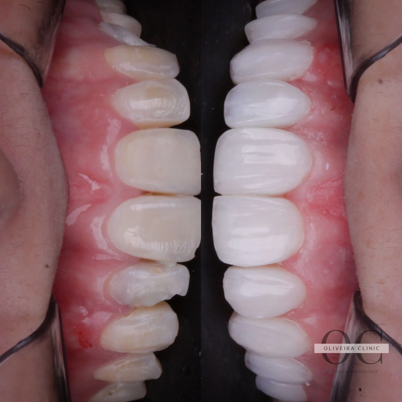 Antes e depois — Comparativo Lateral Detalhado na Oliveira Clinic