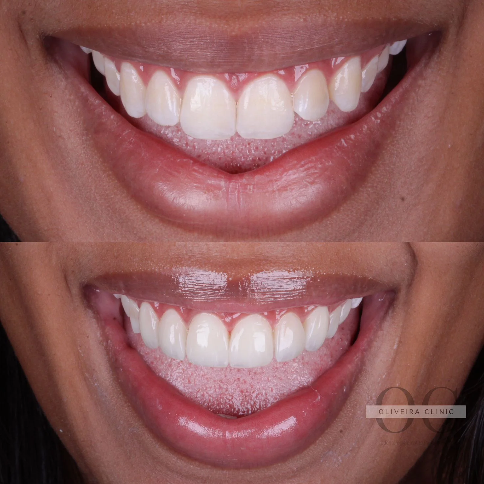 Antes e depois — Design de Sorriso Natural na Oliveira Clinic